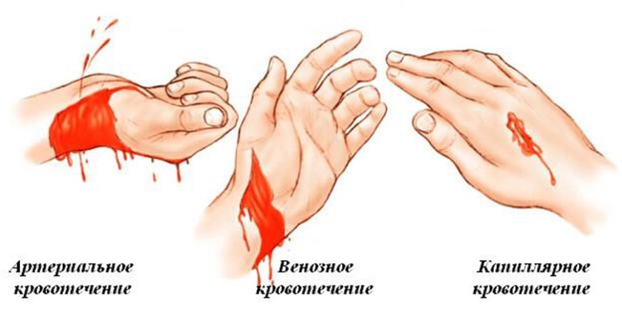Виды кровотечений, первая помощь Виды кровотечений, первая помощь
