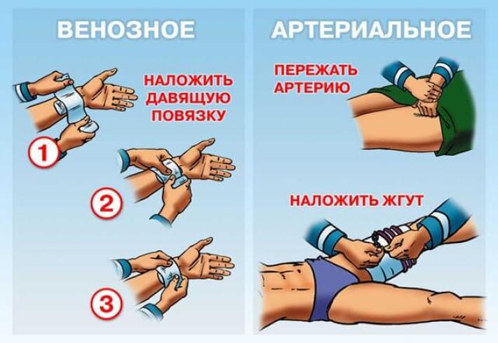 Виды кровотечений, первая помощь Виды кровотечений, первая помощь