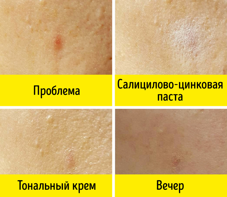 Салицилово-цинковая паста - Бюджетные средства из аптеки, которые работают не хуже дорогой косметики Салицилово-цинковая паста - Бюджетные средства из аптеки, не хуже дорогой косметики