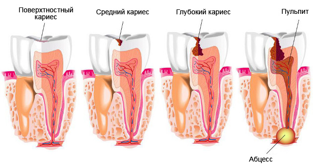 Почему человечество страдает от кариеса, и можно ли с этим бороться Почему человечество страдает от кариеса, и можно ли с этим бороться