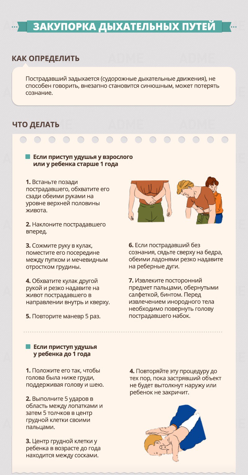 Закупорка дыхательных путей - Гид по оказанию первой помощи Закупорка дыхательных путей - Гид по оказанию первой помощи