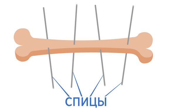 Аппарат Илизарова