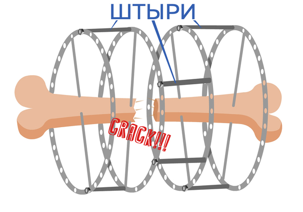 Аппарат Илизарова