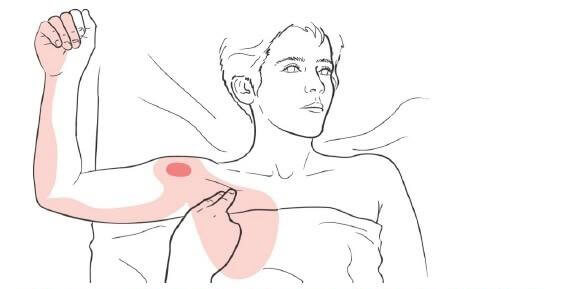 Малая грудная мышца – источник боли, о котором Вы не догадываетесь