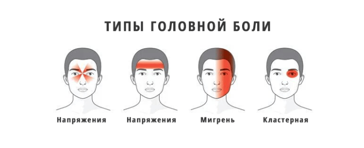 Типы головной боли Типы головной боли